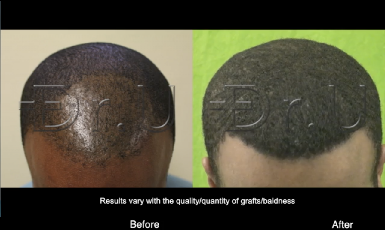 This patient benefited from the manual Dr.UPunch Curl for his curly hair transplant. The latest hair transplant technique innovates on this procedure with the addition of ultrasonic frequencies*