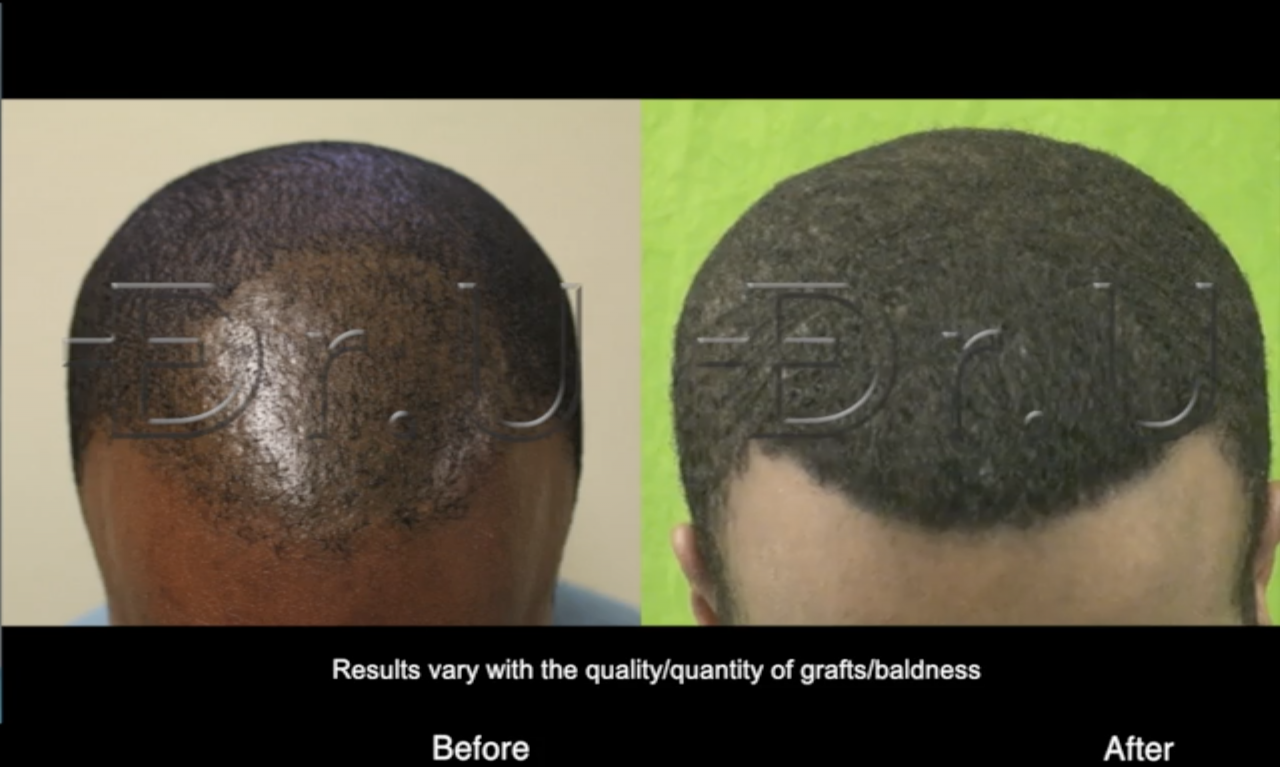 This patient benefited from the manual Dr.UPunch Curl for his curly hair transplant. The latest hair transplant technique innovates on this procedure with the addition of ultrasonic frequencies This patient benefited from the manual Dr.UPunch Curl for his curly hair transplant. The latest hair transplant technique innovates on this procedure with the addition of ultrasonic frequencies*