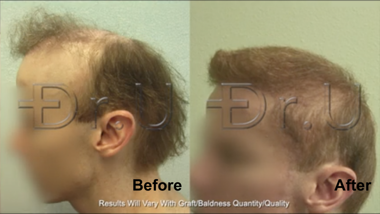 This patient benefited from the best hair transplant doctor tools when previous procedures at other clinics failed to restore his hair.