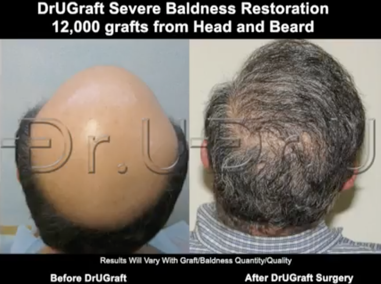 This severely bald patient benefited from a Dr.UGraft™ procedure using 12,000 grafts from the head and beard.