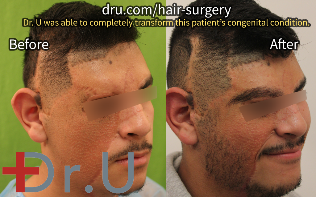 This patient was able to use hair from his legs and nape to restore his eyebrow and the right side of his beard after having his birthmark removed.*