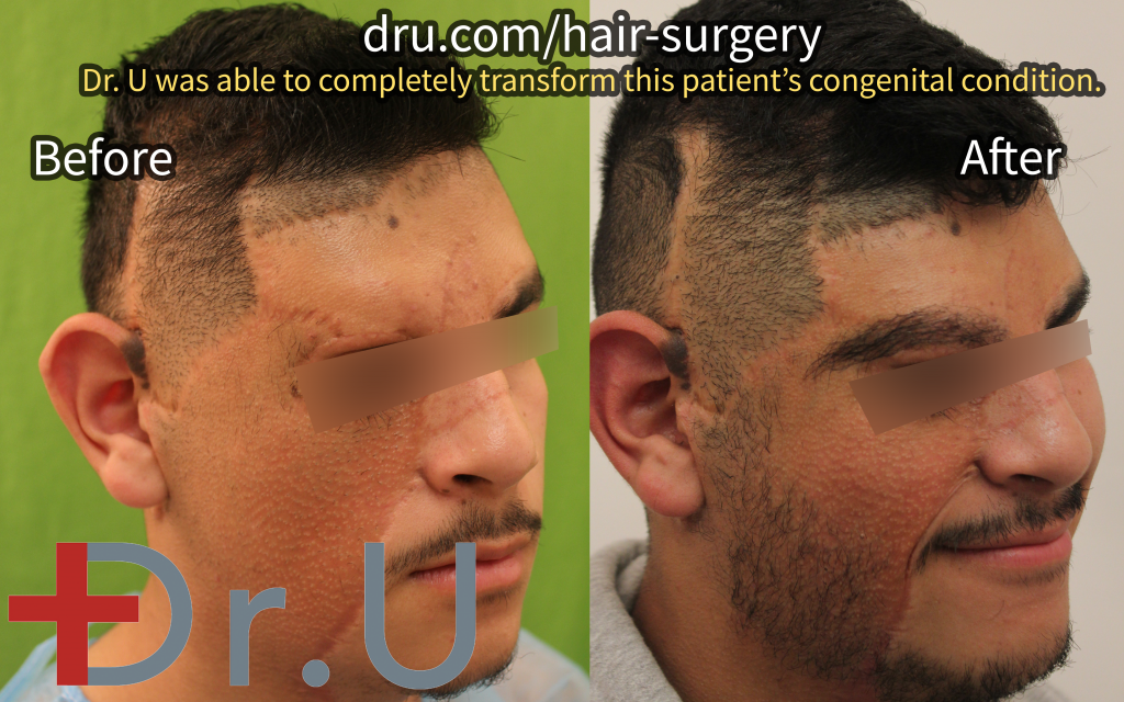 This patient was able to use hair from his legs and nape to restore his eyebrow and the right side of his beard after having his birthmark removed.* This patient was able to use hair from his legs and nape to restore his eyebrow and the right side of his beard after having his birthmark removed.*