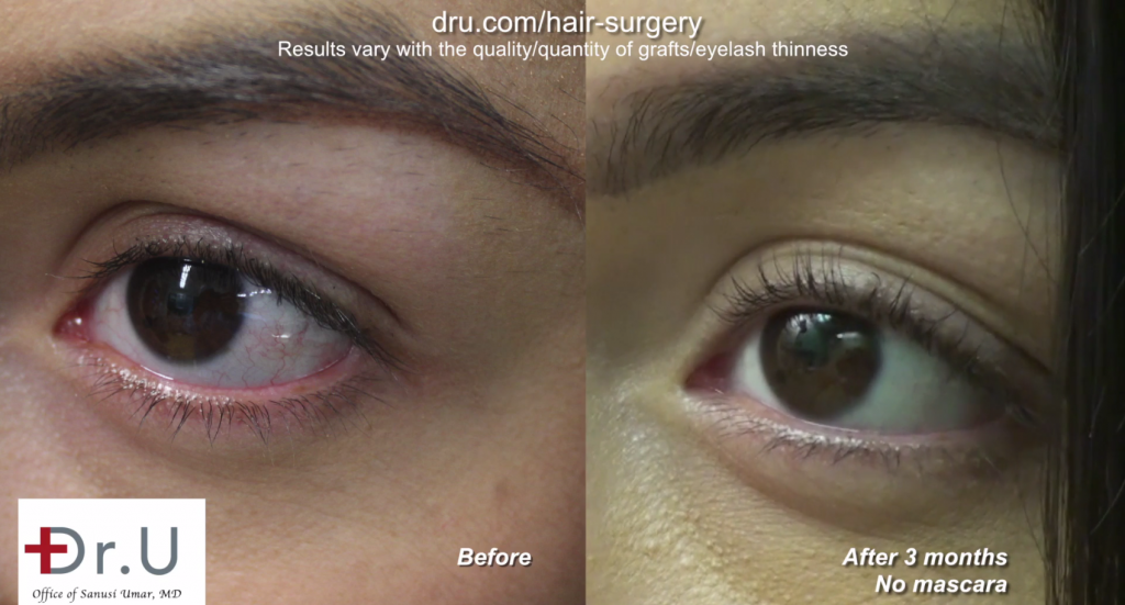 A BHT eyelash transplant performed by Dr. U himself. This patient had a leg hair eyelash transplant and ended up with extraordinary results.* A BHT eyelash transplant performed by Dr. U himself. This patient had a leg hair eyelash transplant and ended up with extraordinary results.*